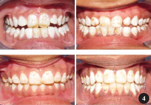 Grade 3 - Severe fluorosis cases among the children examined.