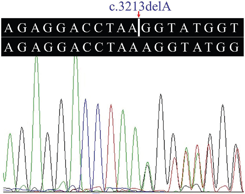 Heterozygous c.3213delA mutation in the collagen type IV alpha-4 gene.