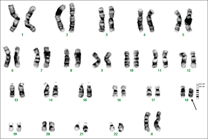 GTG-banded karyotype image of patient 1. The arrow points to the deletion on the ‘p’ arm of chromosome 18.