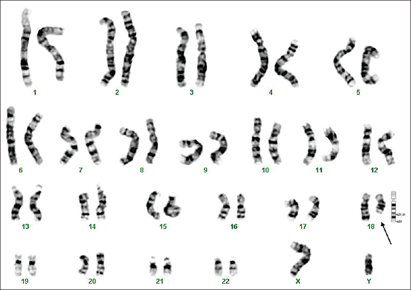 GTG-banded karyotype image of patient 7. The arrow points to the deletion on the ‘q’ arm of chromosome 18.