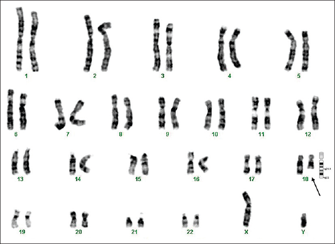 GTG-banded karyotype image of patient 8. The arrow points to the deletion on the ‘q’ arm of chromosome 18.