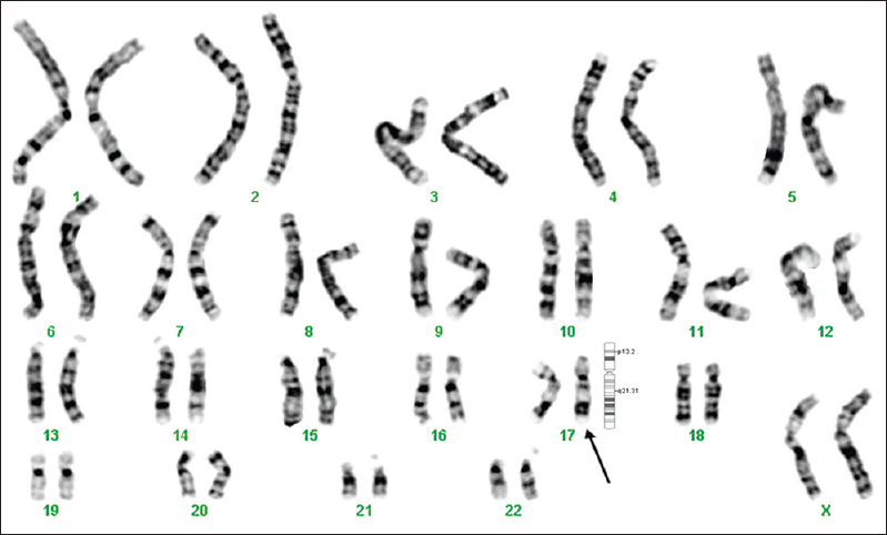GTG-banded karyotype image of patient 6. The arrow points to the pericentric inversion on chromosome 17.