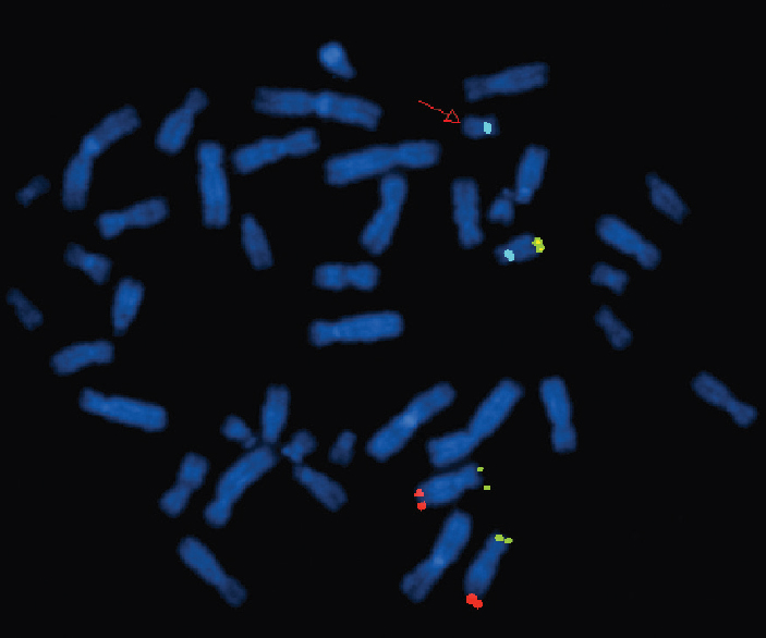 Fluorescence in situ hybridization image of metaphase plates of patient 7 - Mix 12 with probes for telomeres of chromosome 12p (green), 12q (red), 18q (yellow) and control region, centromere 18 (aqua). The red arrow points to the absence of yellow signal on one of the chromosome 18s, indicating a deletion of 18qter.