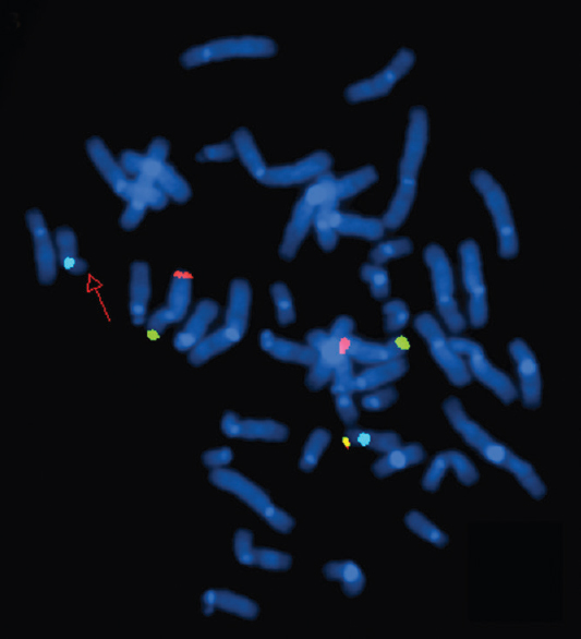 Fluorescence in situ hybridization image of metaphase plates of patient 6 - Mix 8 with probes for telomeres of chromosome 8p (green), 8q (red), 17p (yellow) and control region, centromere 17 (aqua). The red arrow points to the absence of yellow signal on one of the chromosome 17s, indicating a deletion of 17pter.
