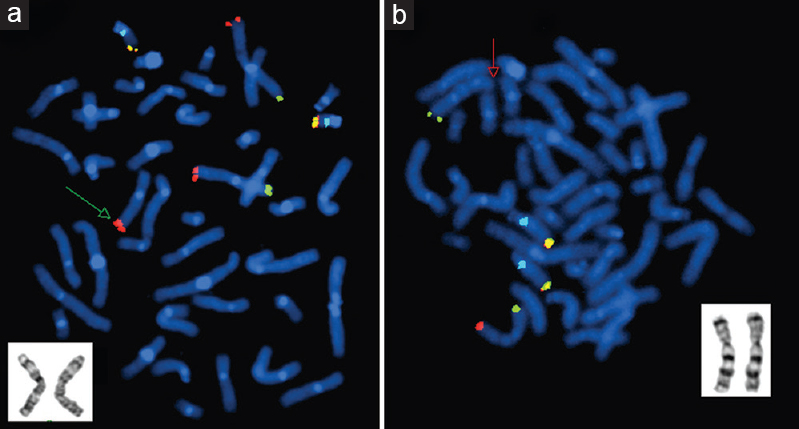 Fluorescence in situ hybridization image of metaphase plates of patient 2 - (a) Mix 3 with probes for telomeres of chromosome 3p (green), 3q (red), and 22q (yellow) and control region, 22q11 (aqua). The green arrow points to the presence of an additional red signal on one of the chromosome 7s, indicating a derivative 7 with duplicated 3qter. GTG-banded partial karyotype in the inset shows both homologues of chromosome 3. (b) Mix 7 with probes for telomeres of chromosome 7p (green), 7q (red), and 14q (yellow) and control region, 14q11.2 (aqua). The red arrow points to the absence of red signal on one of the chromosome 7s, indicating a deletion of 7qter. GTG-banded partial karyotype in the inset shows both homologues of chromosome 7.