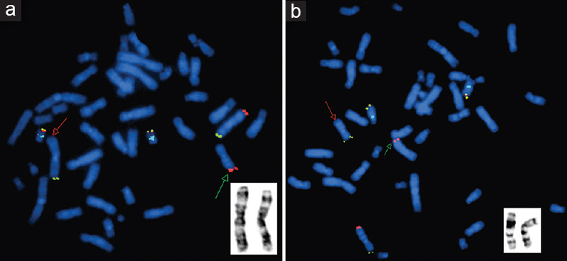 Fluorescence in situ hybridization image of metaphase plates of the mother of patient 2 - (a) Mix 3 with probes for telomeres of chromosome 3p (green), 3q (red), and 22q (yellow) and control region, 22q11 (aqua). The red arrow points to the absence of red signal on chromosome 3qter, and green arrow points to the presence of red signal on chromosome 7qter, indicating t(3;7). GTG-banded partial karyotype in the inset shows both homologues of chromosome 3. (b) Mix 7 with probes for telomeres of chromosome 7p (green), 7q (red), and 14q (yellow) and control region, 14q11.2 (aqua). The red arrow points to the absence of red signal on chromosome 7qter, and the green arrow points to the presence of red signal on chromosome 3qter, indicating an apparently balanced reciprocal t(3;7). GTG-banded partial karyotype in the inset shows both homologues of chromosome 7.