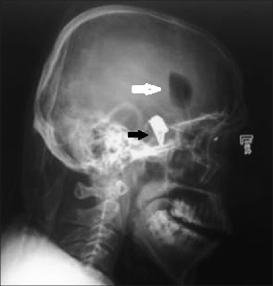 Plain radiograph of the skull (lateral view) showing cartridge lodged in sella (black arrow) along with pneumocephalus (white arrow).