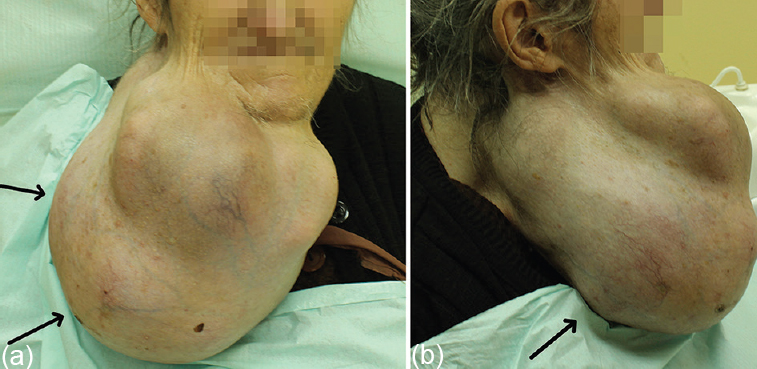 (a) Patient with a pended, lobulated mass on the right side of the neck (arrows), frontal view. (b) Patient with a mass on the right side of the neck (arrows), lateral view.
