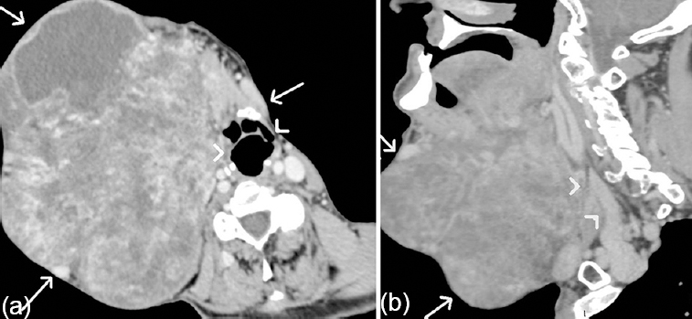 (a) Axial post-contrast computed tomography scans showing heterogeneous, lobulated tumoural mass (arrows) with displacement of the airway (arrowheads). (b) Sagittal post-contrast computed tomography scans showing tumoural mass (arrows) with compression of internal jugular vein (arrowheads).
