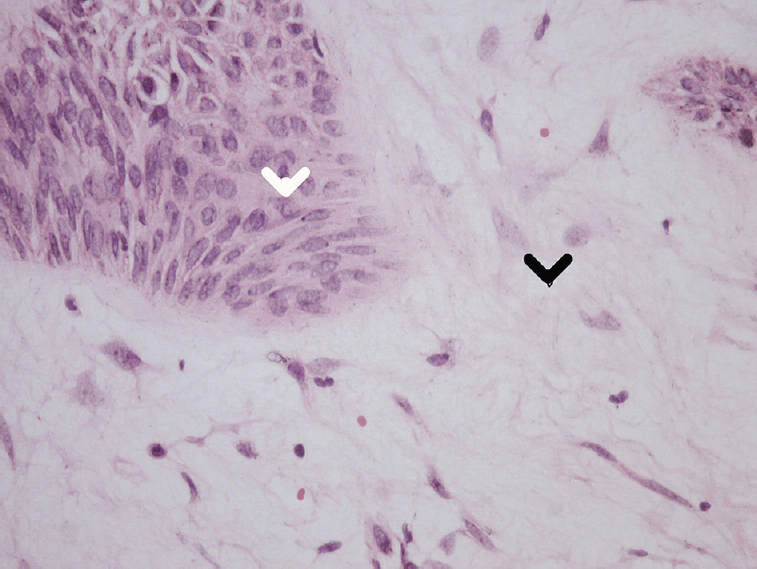 Histopathology findings showed pleomorphic adenoma of submandibular gland composed of myxoid stroma (black arrowhead) and epithelial cells (white arrowhead) (Haematoxylin & Eosin, ×40).