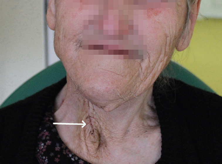 Patient at six month follow up. Post-operative scar is present, with no evidence of recurrence (arrow).