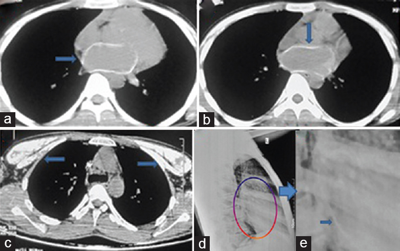 Computed tomography (a-c) and chest X-ray (d magnified in e) showing cardiac calcification (predominantly in the left atrial) and skeletal muscle (c) calcification (shown by arrows).
