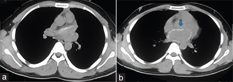 Computed tomography of chest (a & b) showing resolution of skeletal muscle calcification but cardiac (left atrial) calcification persisted (arrow).