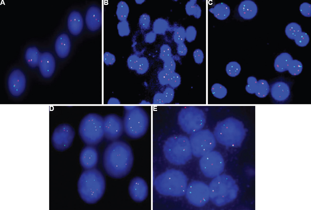 (A) Dual colour IgH break apart probe on interphase cells shows normal IgH allele (yellow signal) and residual IgH (1 red signal and 1 green signal). (B) LSI IgH/CCND1 XT dual fusion probe on interphase cells shows dual fusion of IgH-CCND1 (1R1G2Y). (C) LSI IgH/FGFR3 dual fusion probe on interphase cells shows one copy of FGFR3 (1 red signal), two copies of IgH (2 green signals) and 2-3 copies of IgH-FGFR3 (2-3 yellow signals). (D) LSI IgH/MAF dual fusion probe on interphase cells shows 1-2 copies of MAF (1-2 red signals), 1-2 copies of IgH (1-2 green signals) and 1-3 copies of fusion signals of IgH-MAF (1-3 yellow signals). (E) LSI IgH/MYC dual fusion probe on interphase cells shows normal allele of MYC (1 red signal), normal allele of IgH (1 green signal) and dual fusion signal of IgH-MYC (2 yellow signals).