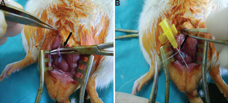 (A) Blunt dissection between the urethra and the corpus cavernosum with hanging of urethra (arrow). (B) The process of narrowing the urethral lumen over a catheter (arrow).