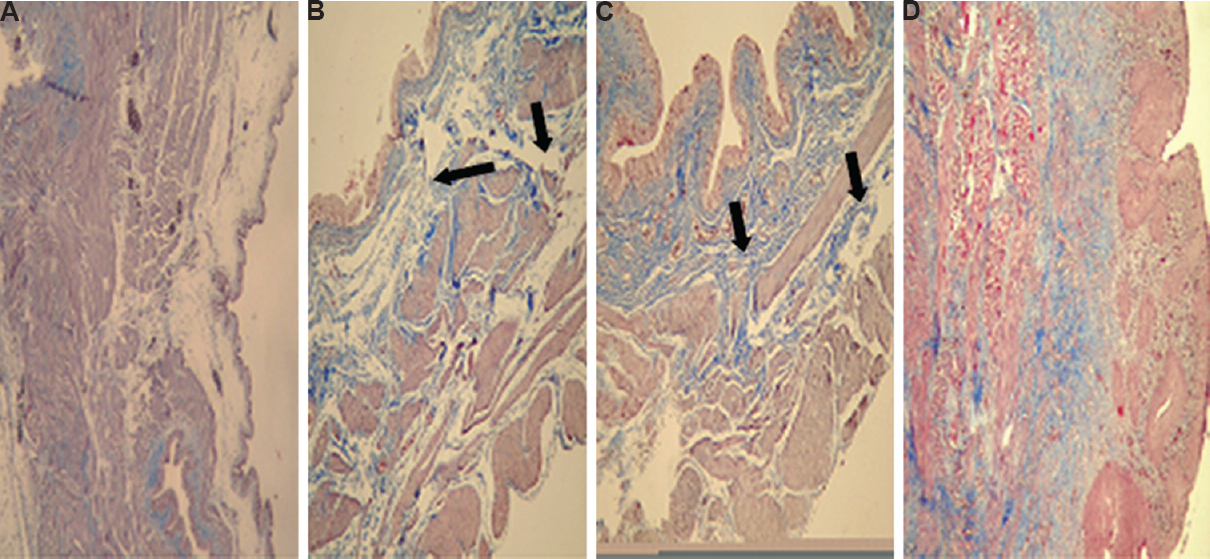 (A) Collagen (not increased) in the lamina propria and muscularis propria (fibrosis grade 0) (MTC, ×200). (B) The photomicrography shows the increased thin bands (arrows) of collagen (fibrosis grade 1) (MTC, ×200). (C) Increased thick bands (arrows) of collagen (fibrosis grade 2) (MTC, ×200). (D) The photomicrography shows diffuse increased collagenous tissue (fibrosis grade 3) (MTC, ×200).