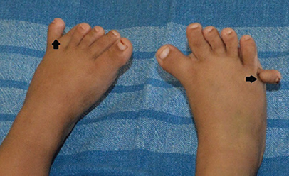 Polydactyly (arrows) involving both feet.