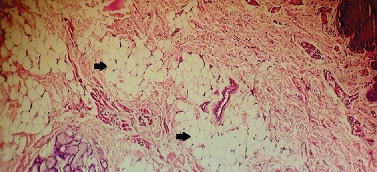 Section showing collection of mature fat cells separated by fibrous septa (arrows) (H & E, ×40).