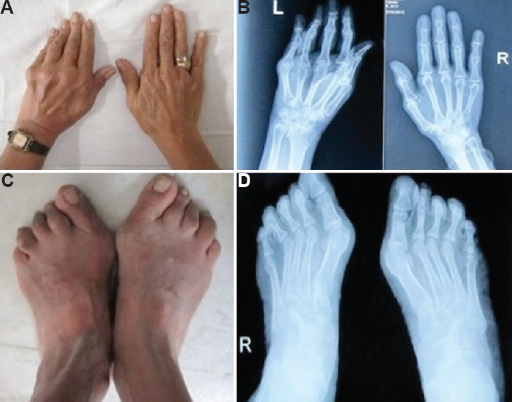 Striatal hand showing flexion at metacarpophalangeal joint with extension at interphalangeal joint and ulnar deviation of the left hand (A), which was confirmed by hand X-rays (B), striatal toe showing lateral flexion of the great toe with flexion of other toes (C), which was confirmed by foot X-rays (D).