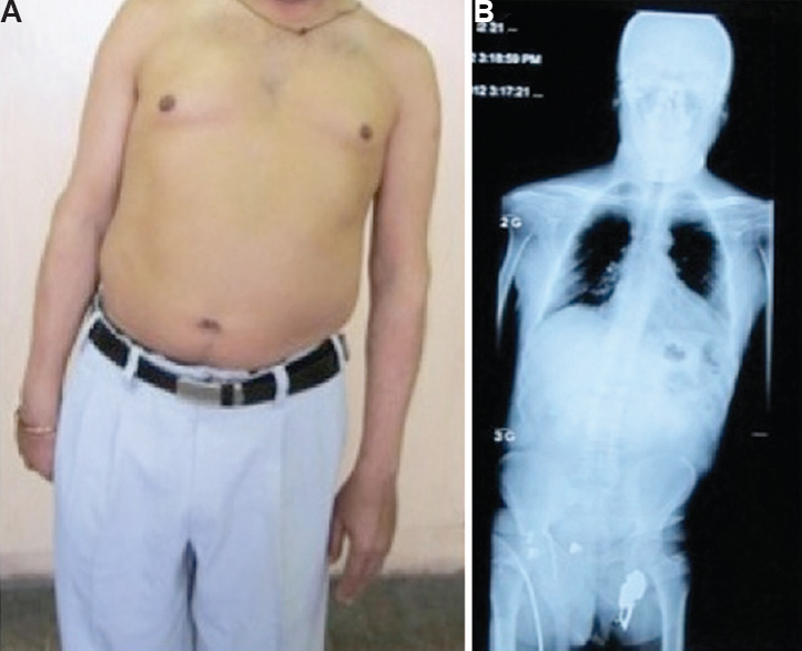 Pisa syndrome in a patient with Parkinson's disease characterized by leaning towards left side (A), which was confirmed by spine X-rays (B).