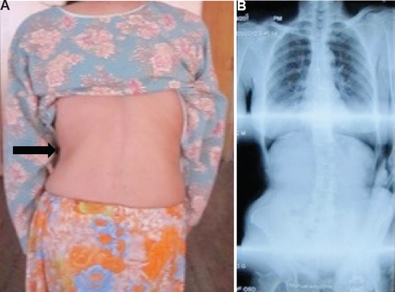 A patient with Parkinson's disease with scoliosis with concavity towards left side (A), which was confirmed by spine X-rays (B).