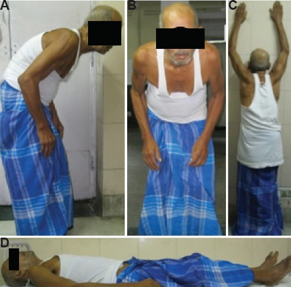 Camptocormia in a patient with Parkinson's disease (A and B), which was corrected by pushing against wall (C) and while lying down (D).
