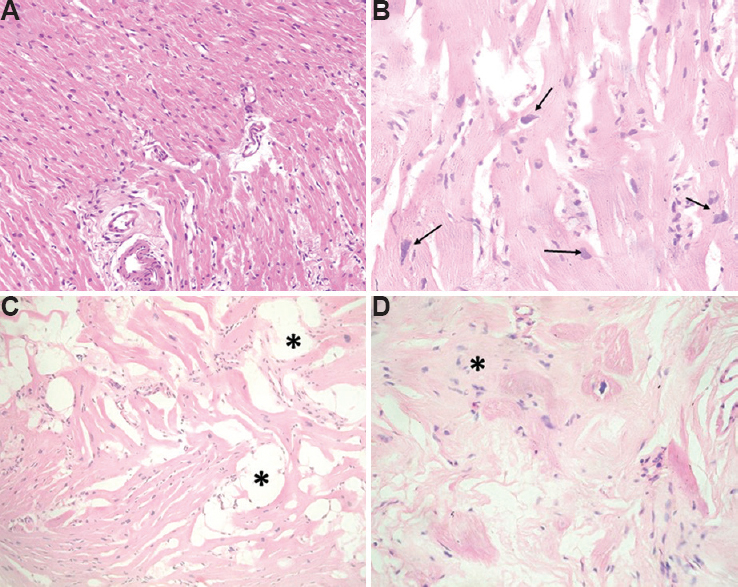 Sections from myocardial biopsy (hematoxylin and eosin) showing (A) normal myocardium, (B) myofibrils with features of nuclear degeneration (arrows) with presence of nuclear enlargement, irregular nuclear contours and granular chromatin (×400), (C) interstitial deposition (asterisks) of mature adipose tissue (×200), (D) myofibril disarray (asterisk), fibre atrophy and marked interstitial fibrosis (×400).