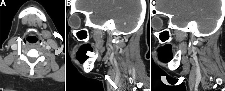 (A) Axial contrast-enhanced computed tomography (CECT) of neck shows absent right submandibular gland (white arrow) in right submandibular fossa and hypertrophied left submandibular gland (curved arrow). (B) Sagittal reformat of CECT shows absent right submandibular gland in right submandibular fossa (white arrow). (C) Sagittal reformat of CECT shows hypertrophied left submandibular gland (curved arrow).