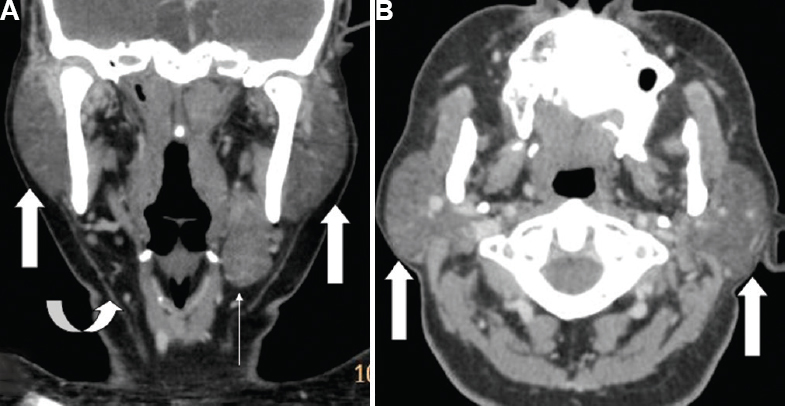 (A) Coronal reformat of contrast-enhanced computed tomography (CECT) of neck shows hypertrophied bilateral parotid glands (white arrow), absent right submandibular gland in right submandibular fossa (curved arrow) and hypertrophied left submandibular gland (thin white arrow). (B) Axial CECT shows hypertrophied bilateral parotid glands (white arrow).