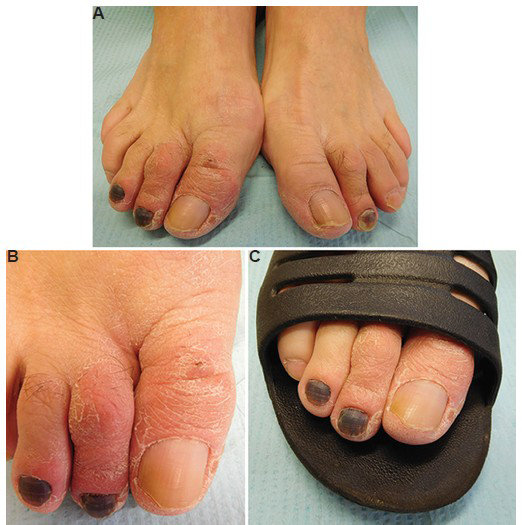Distant (A) and closer (B) views of the right foot of a 62 yr old man who presented with ketoprofen-induced photoallergic dermatitis of the right three medial toes. He had chronic arthritic pain of the right great toe; the right second and third toes had more recently become painful after he had gone hiking and developed subungual haematomas of these toes and the left second toe. The patient applied ketoprofen gel to the medial three toes of the right foot to relieve pain and subsequently exposed them to sunlight while wearing sandals outside (C). Other areas of the body on which he applied ketoprofen gel but did not expose to sunlight did not develop dermatitis. Only the right three medial toes that were exposed to sunlight developed a photoallergic reaction. The patient was treated with triamcinolone 0.1 per cent cream and instructed to avoid oxybenzone sunscreen, and the redness and scaling resolved within one week.
