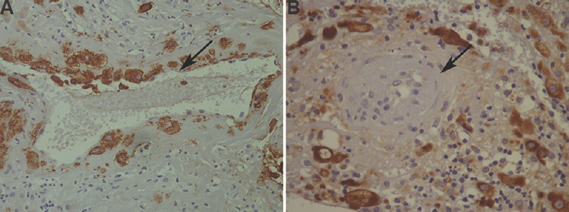 Distribution of trophoblastic cells in a decidua: (A) transformed spiral artery with presence of trophoblastic cells in more than a half of the circumference of the artery (arrow; CK7, ×400) (B) untransformed spiral artery, trophoblastic cells are present only in the decidual stroma (arrow; CK7, ×400).