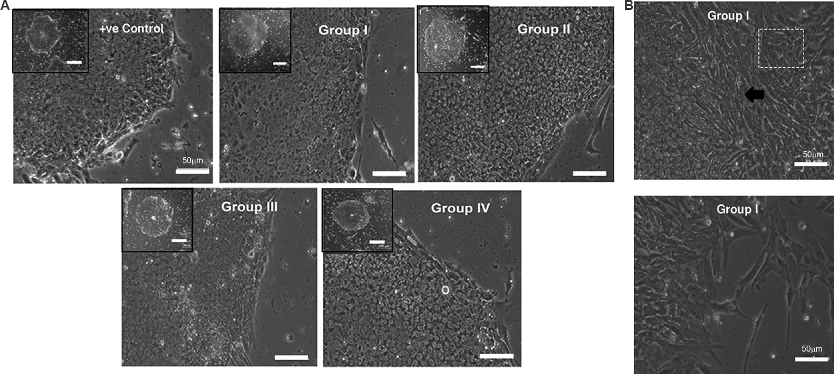 KIND-1 human embryonic stem cells (hESC) retain in vitro pluripotency in I-HFF conditioned medium lacking exogenous bFGF in feeder-free system: (A) Morphology of hESC colonies cultured under different groups of I-HFF-conditioned medium. Human embryonic stem cell colonies have clear defined borders with high N/C ratio. Scale bar=50 μm and magnification ×10. Inset (Scale bar=200 μm) showing a single colony. (B) Phase contrast images of hESC-derived fibroblast-like cells that appeared in group I of I-HFF conditioned medium. Black arrow and boxed area show the hESC-derived fibroblast-like cells outgrowth from hESC colonies. The lower panel of image shows hESC-derived fibroblast-like cells alone.