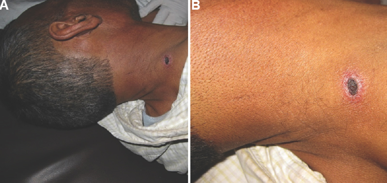 Eschars in patients with scrub typhus. (A) An eschar on the neck of a patient with scrub typhus. (B) A close up of the eschar shows the typical cigarette burn appearance of an eschar.