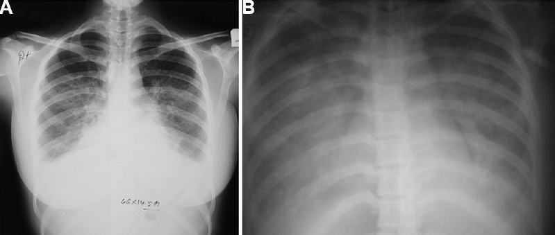 (A) A patient with scrub typhus presenting with fever and shortness of breath. X-ray shows an interstitial pattern with ground glass opacities in bilateral lower lobes. (B) An X-ray of a patient with scrub typhus who progressed rapidly to acute respiratory distress syndrome. X-ray showing extensive air space consolidation.