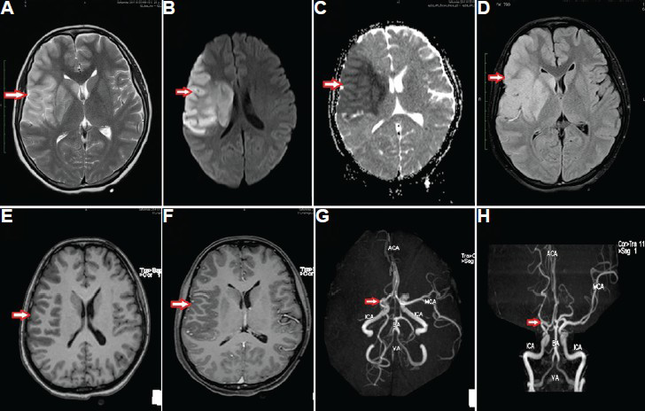 Contrast magnetic resonance imaging of brain: Large area of T2W and fluid-attenuated inversion recovery hyperintensity (arrow in A and B) in the right fronto-temporo-parietal region with diffusion restriction (arrow in C) appearing hypointense in apparent diffusion coefficient (arrow in D) without contrast enhancement (arrows in E and F). Magnetic resonance angiogram showed absent signal in the right middle cerebral artery (arrows in G and H).