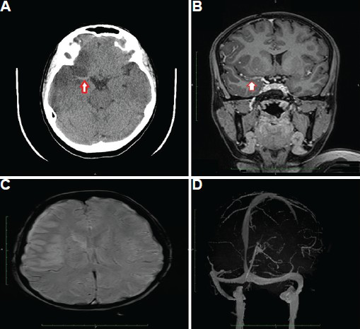 Contrast magnetic resonance imaging of brain: Axial computed tomography scan image (A) and coronal T1 fluid-attenuated inversion recovery image (B) showing thrombus in M1 segment of the right middle cerebral artery (arrows). Susceptibility weighted image (C) did not show areas of blooming and magnetic resonance venogram (D) was also normal.
