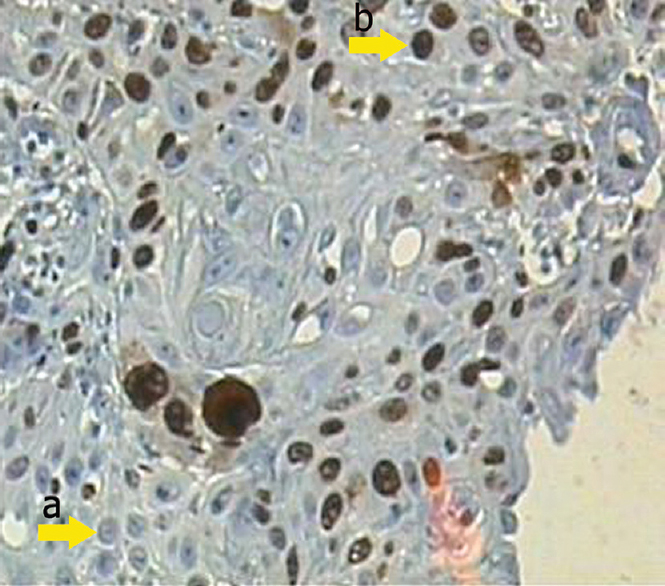 The moderate Ki-67 expression shows positive nuclear staining belonging to group B by immunohistochemistry (IHC, ×400). Arrows a and b demonstrate the negative and positive nuclear staining, respectively.