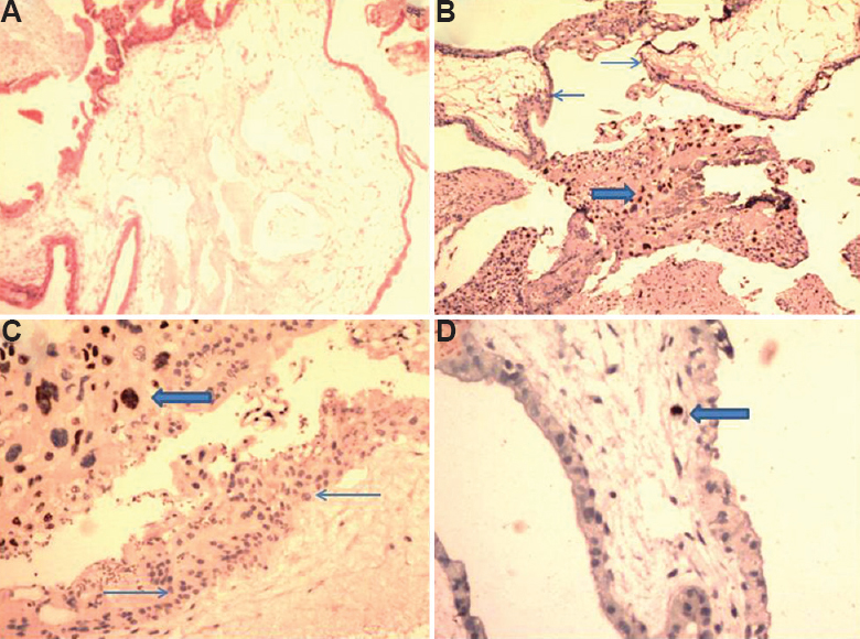 A case of complete mole showing (A) villous oedema with cistern formation (H & E, ×40); (B and C) p57 negativity in cytotrophoblast (thin arrows) with positivity in extravillous site (thick arrow; IHC, ×40 and ×100 respectively); (D) occasional stromal macrophage showing positivity (thick arrow; IHC, ×200).