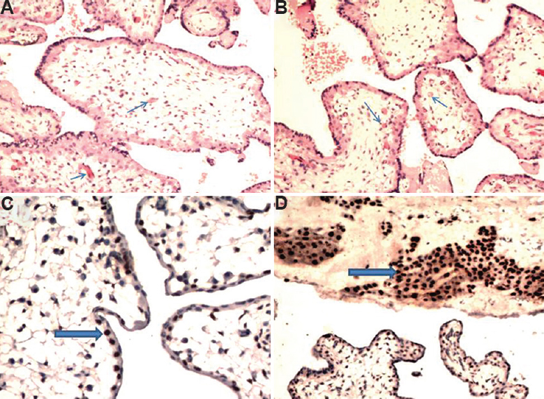 A case of hydropic abortus showing (A and B) villous oedema involving almost all villi; however, villi are vascularized (thin arrows) and do not show trophoblastic hyperplasia (H & E, ×100); (C) p57 positivity in cytotrophoblast (thick arrow; IHC, ×200); (D) p57 positivity in decidua (thick arrow; IHC, ×100).