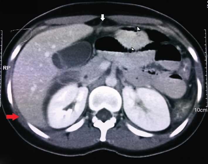 A computerized tomogram of the abdomen revealed a thickened liver capsule and subcapsular fluid (red arrow), suspicious adhesions between the liver capsule and anterior peritoneum (vertical arrow) and between the inter-bowel loops (arrowheads), diffuse colonic wall thickening and moderate ascites.