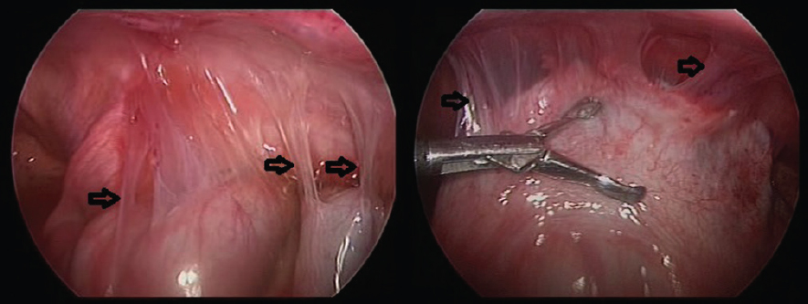 The flimsy “violin string-like adhesions” on laparoscopic examination (arrows).