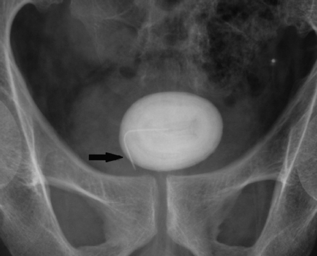 Pelvic radiograph showing a vesical stone with a foreign body at the centre (arrow).
