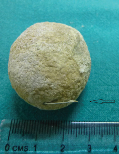 A vesical stone with a needle (arrow).
