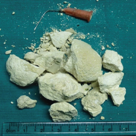 A hypodermic needle was found after the stone was fragmented.
