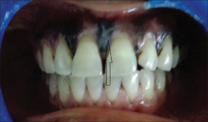 Black pigmentation on the labial aspect of maxilla (arrow).
