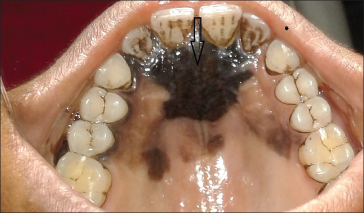 Black pigmentation on the palatal aspect of maxilla (arrow).