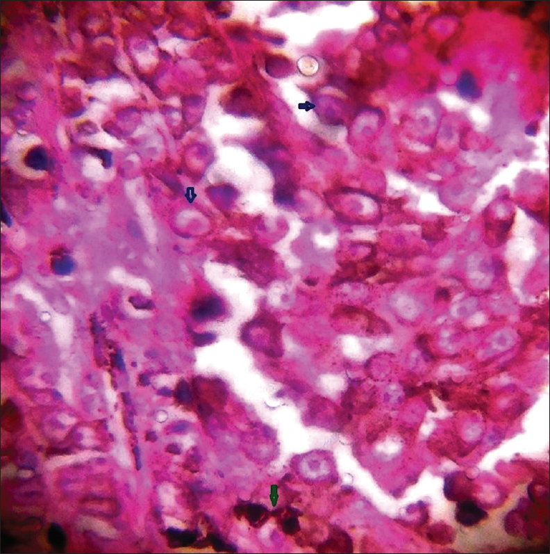 Photomicrograph of hematoxylin and eosin (H&E) stained section (×100) showing haphazardly distributed atypical melanocytes having high N/C (nucleus/cytoplasm) ratio with macronuclei (blue arrows) and melanin pigment secreted by melanocytes (green arrow).