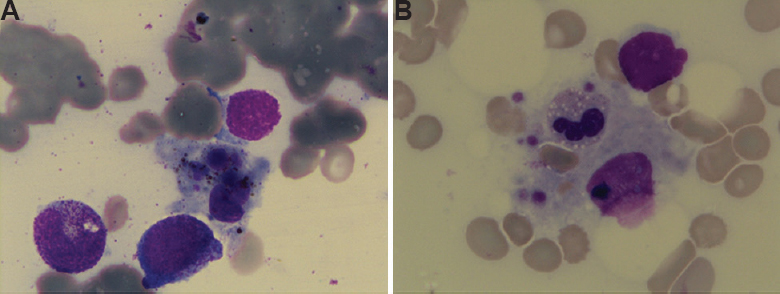 (A)Hamophagocytosis seen on the bone marrow aspiration smear of case 1. (B) Bone marrow aspiration smear of case 2 showing haemophagocytosis with leucocytes, erythrocytes and platelets inside a macrophage.
