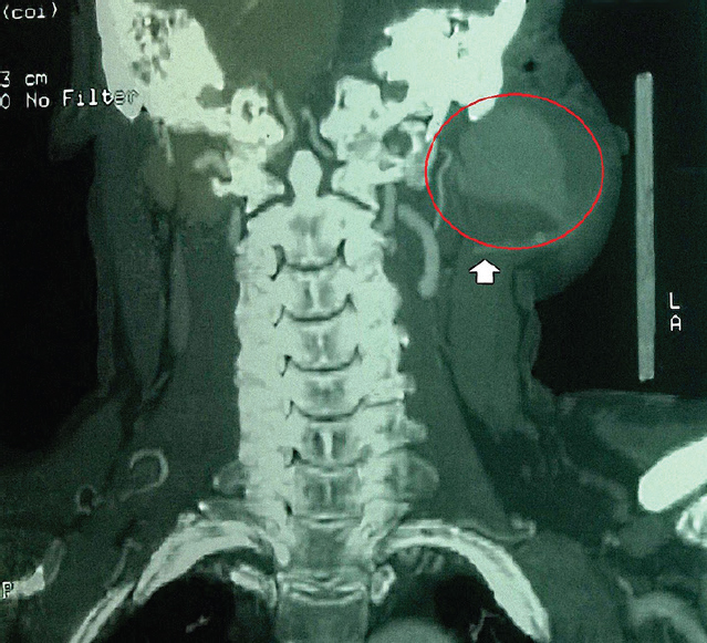 Computed tomography angiogram of the neck showing a saccular aneurysm of the left maxillary artery involving the left masticator, parapharyngeal and infratemporal spaces. The red circle points out the maxillary artery aneurysm.