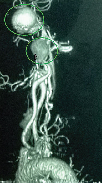 Computed tomography angiogram (coronal cuts) of the same patient showing a concomitant left internal carotid artery aneurysm (green circles) along with the left maxillary artery aneurysm.